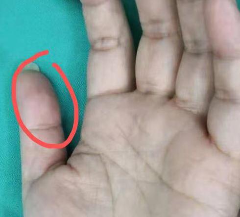 手指被扎了有异物挂什么科,手指被刺伤用什么药