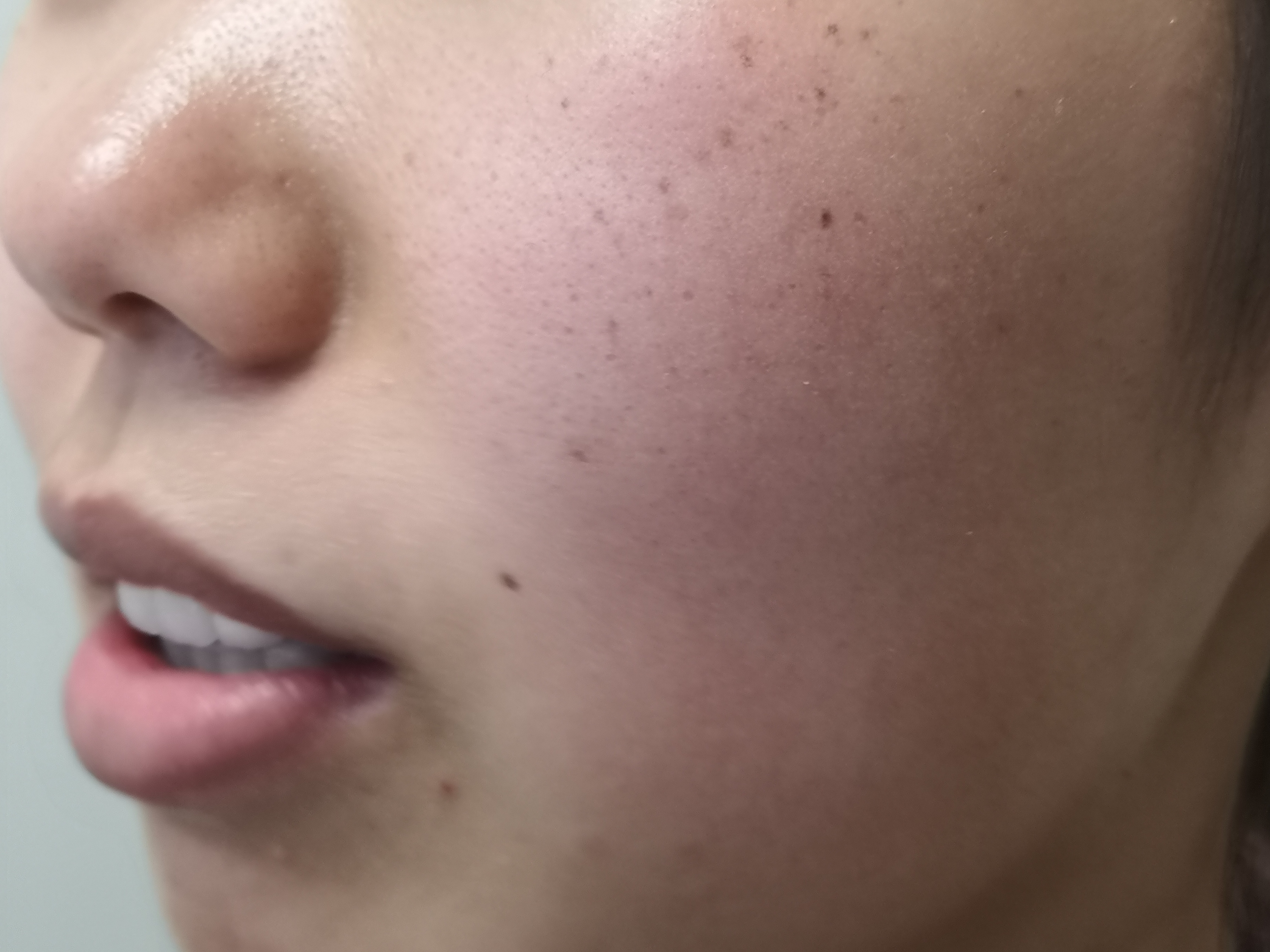 祛斑内调好还是外用好,冬季祛斑正确用法