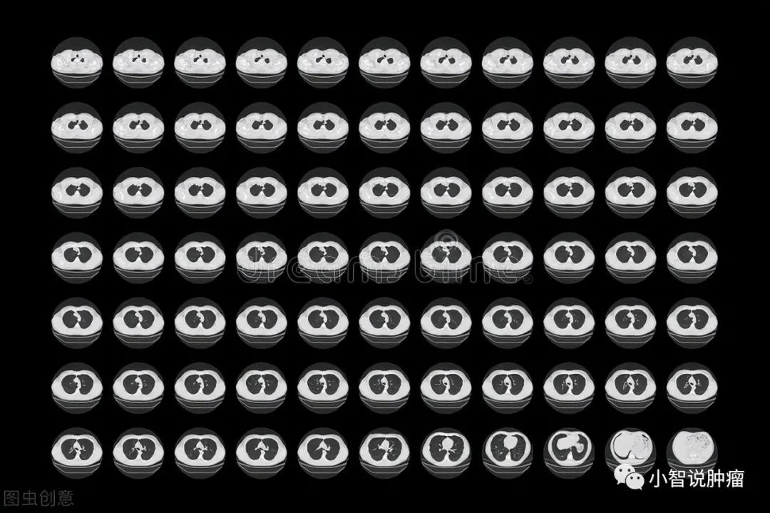 年年体检却查出癌晚期,年年体检正常却被诊断为癌症晚期