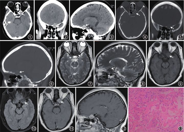 放射性脑损伤是一个渐进过程,起病隐匿,诊断困难,患者需注意