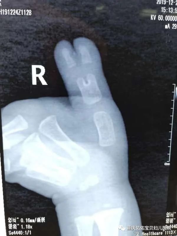 孩子出现多指畸形该怎么办,宝宝脚趾畸形多指最佳治疗时间