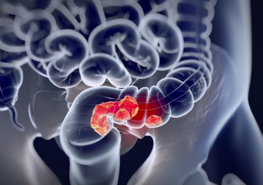 十几天没拉便便,十几天没拉大便怎么回事