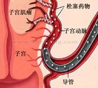 多发性肌瘤必须做子宫切除手术吗,10公分大肌瘤能微创手术吗