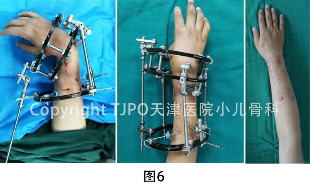 桡骨小头畸形截骨矫形,小儿尺桡骨远端发育迟缓畸形