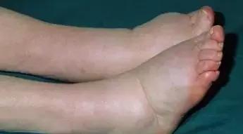 孕晚期会阴肿痛怎么样有助于消肿,孕晚期脚肿怎么快速消肿