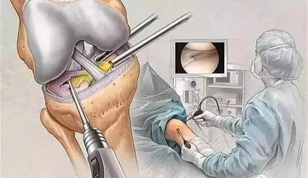 半月板损伤康复,儿童半月板损伤