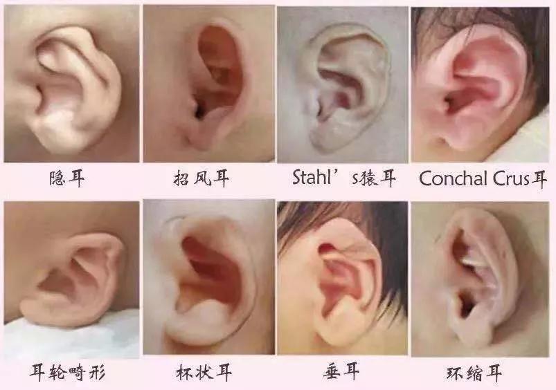 新生儿耳廓畸形需要抹什么药定型,新生儿耳朵轮廓畸形家长怎么办