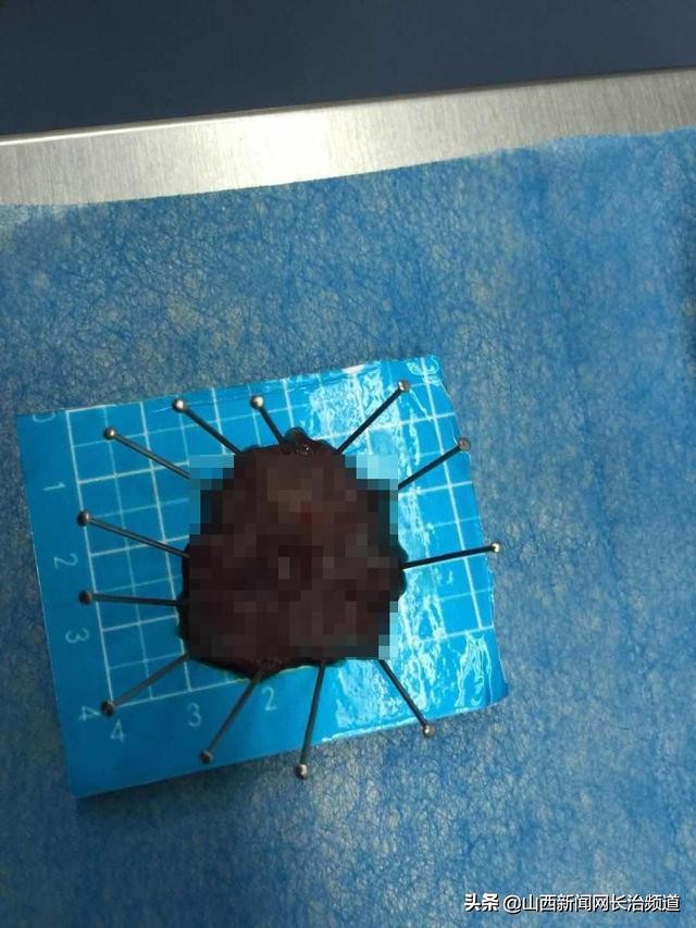 内镜下如何微创治疗早期胃癌,内镜微创治疗早期胃癌