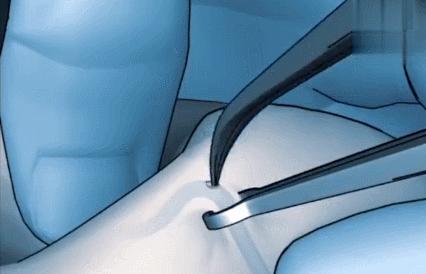 夫妻谁去结扎最好,夫妻两人谁结扎好一点