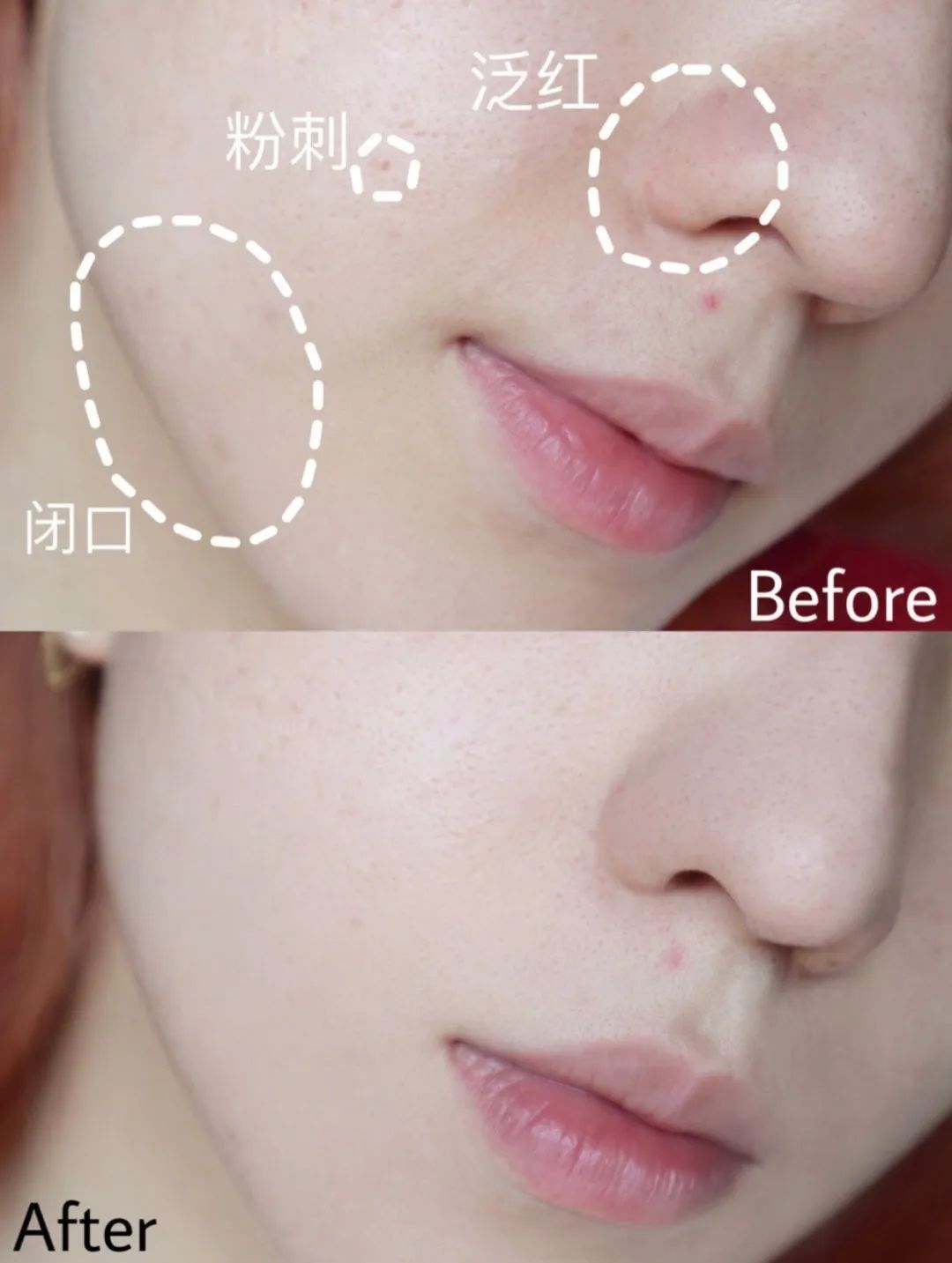 换季过敏烂脸爆皮用什么面膜,换季过敏脸上泛红长痘用什么面膜