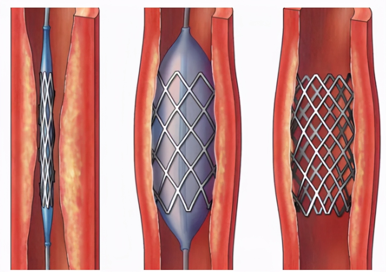 颈动脉狭窄安了支架还是晕,颈动脉堵塞脑梗偏瘫恢复需要多久