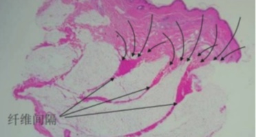 抗皱紧致热玛吉,家用热玛吉淡化皱纹提拉紧致