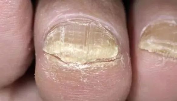 脚部一旦出现这3种情况,什么病会在脚部出现症状