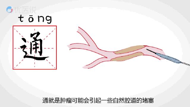 颅内肿瘤微创介入的条件,广东哪家医院肿瘤微创介入治疗好