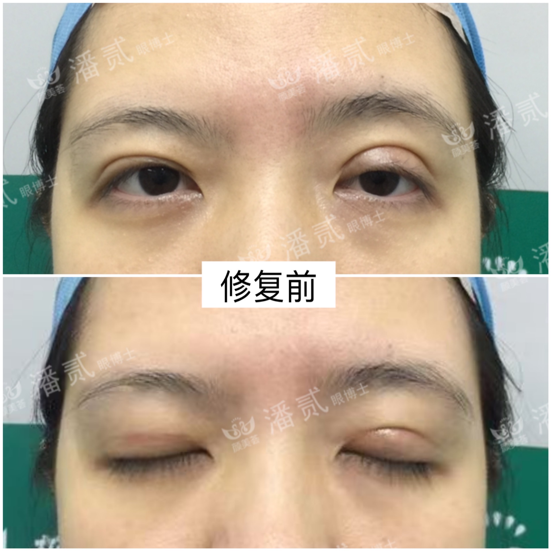 双眼皮手术后问题,双眼皮术后怎么才知道恢复好了没
