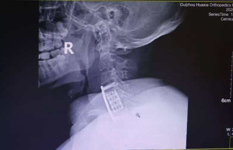 颈椎病手麻手痛怎么治疗,颈椎病手麻无力怎么锻炼
