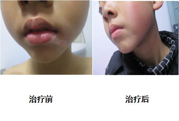 白癜风一年没扩散还一直在恢复,三个月可以治愈白癜风吗