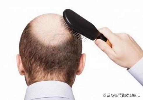 脱发了真的很难受,脱发好烦恼