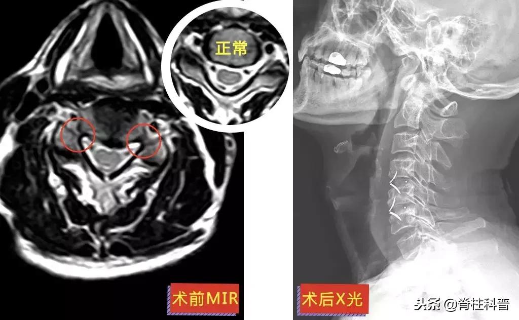 颈椎病治疗的分享,关于颈椎病通俗易懂的科普