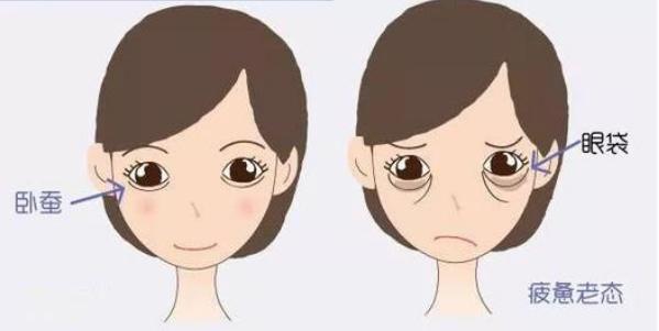 卧蚕和眼袋傻傻分不清的说说,眼袋卧蚕泪沟傻傻分不清楚