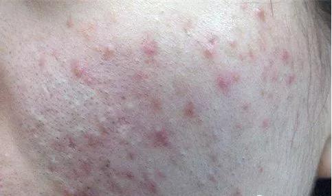 油敏干敏是什么症状,如何区别干敏和油敏