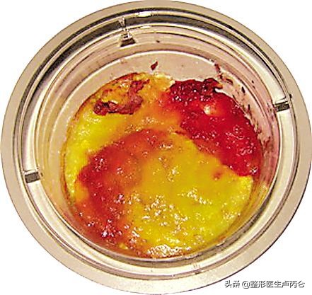 微整形玻尿酸操作流程 (玻尿酸微整形是哪个国家兴起的)