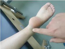 跑步跟腱炎最好的治疗方法,跟腱炎跑步不疼跳起来疼