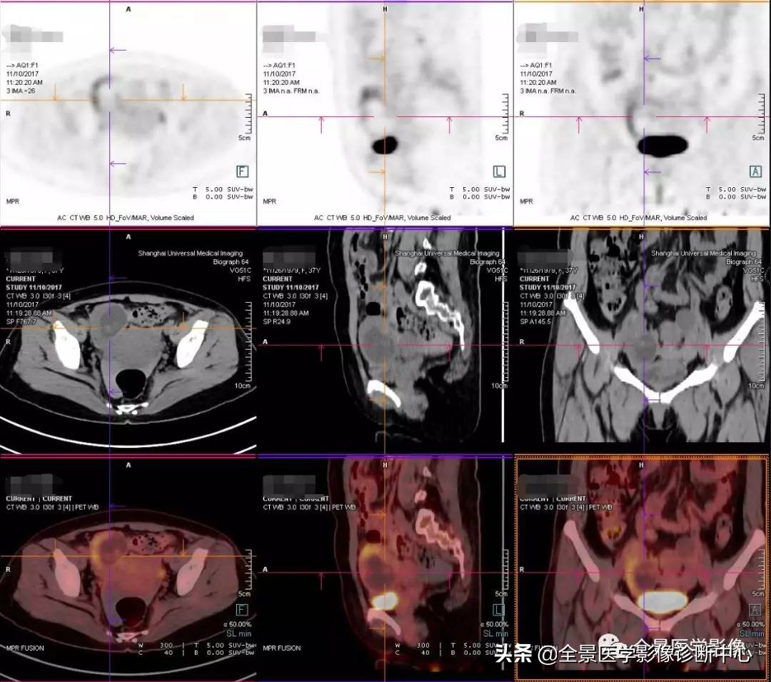 “宫外孕”生死时速8小时