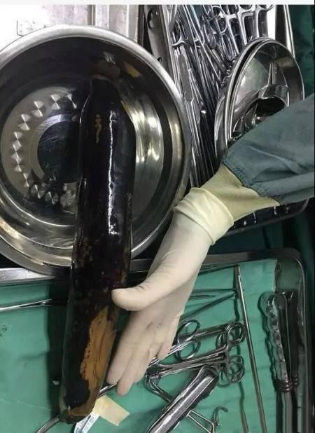 外科切下来肉该怎么处理,医院里手术切下来的东西哪里去了