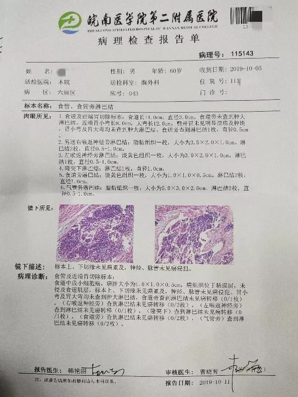 小细胞食管癌化疗几次,小细胞食道癌抗癌案例