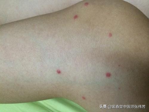 老年人手臂上长紫色斑块,老年色素性紫癜全身发痒怎样治疗