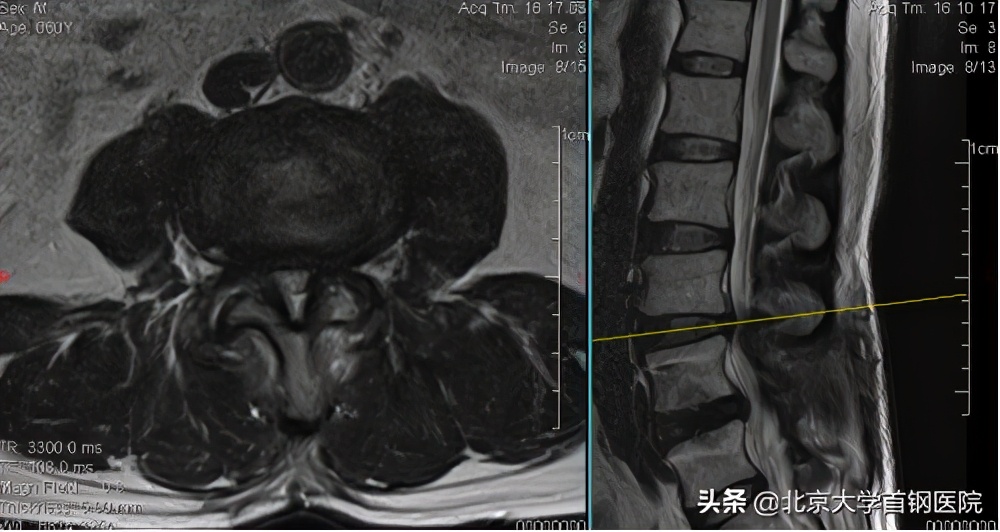 北京大学首钢医院骨科UBE技术彰显新实力