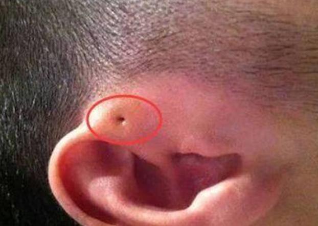孩子耳朵上长了一个疙瘩挂什么科,宝宝耳朵内壁长了个小孔