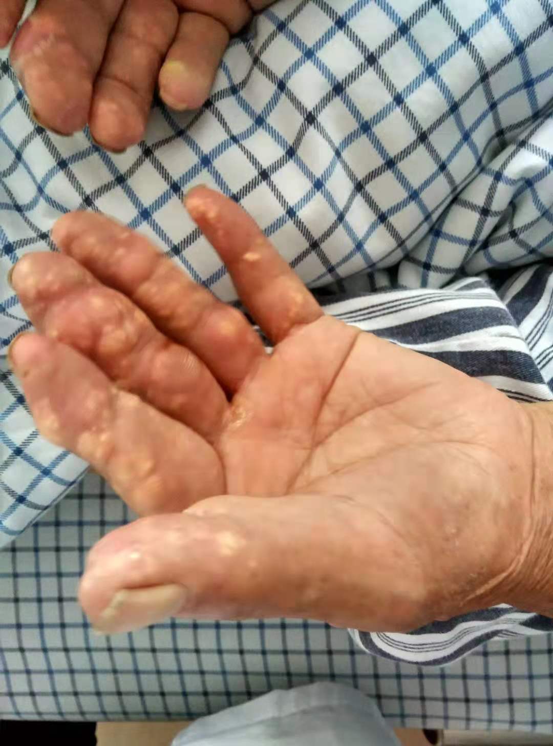 啤酒容易痛风还是白酒容易痛风,啤酒加海鲜痛风是真的吗