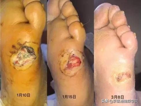 糖尿病最怕「糖尿病足」的出现或加重，专家教你6招巧预防