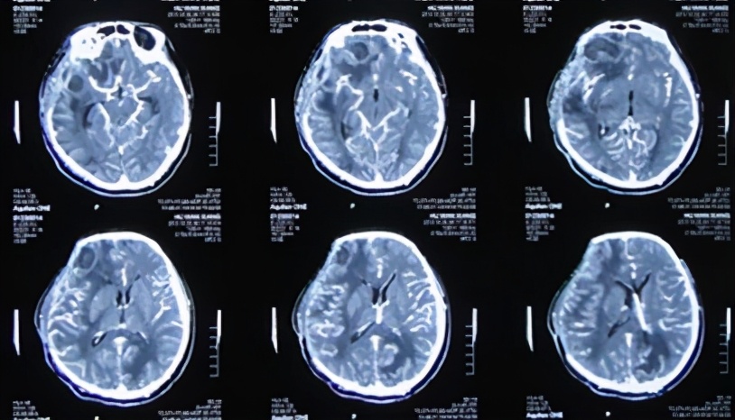 脑外伤开颅手术后脑积水,脑外伤手术后脑脊液鼻漏怎么治疗