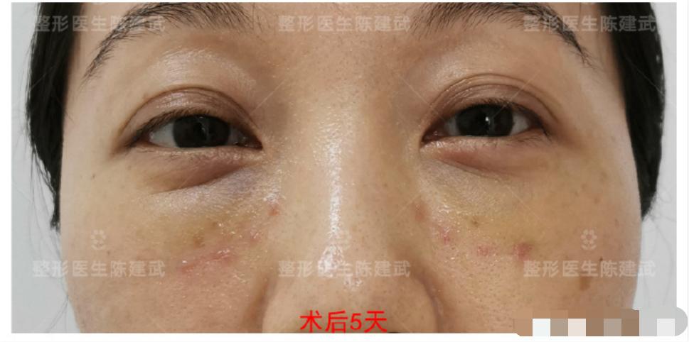 37岁小姐姐分享：眼袋消失后，卧蚕开始尽情展现魅力