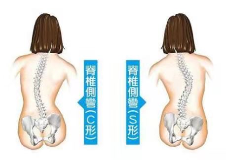怎么矫正高低肩长短腿,脊柱侧弯高低肩瑜伽体式纠正