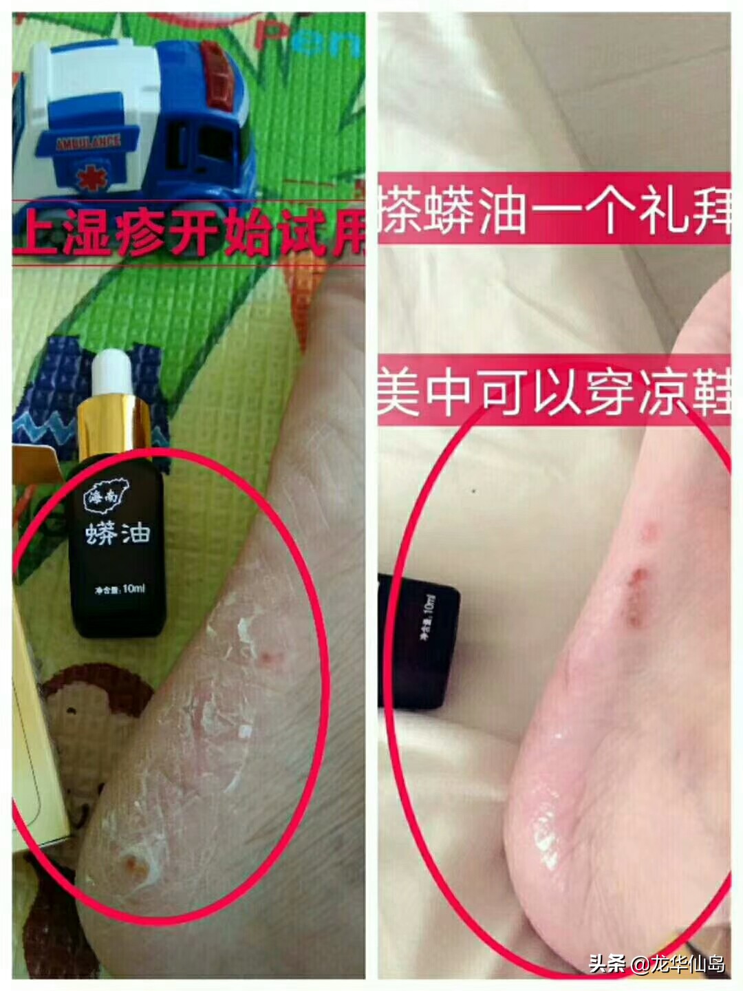 蟒蛇油使用案例与方法
