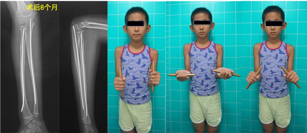 两个儿童前臂骨折争议病例之——元芳你怎么看