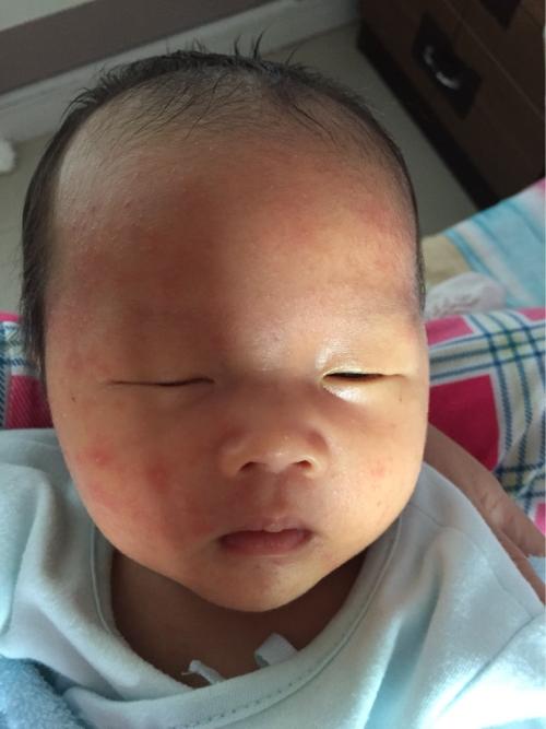 过敏宝宝为什么这么多,过敏体质的宝宝越来越多