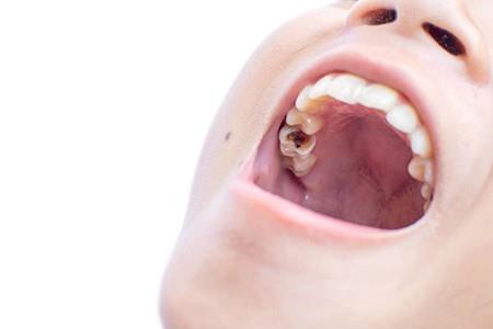 牙齿表面上长黑斑是怎么回事,牙齿上有黑色牙迹怎么去除