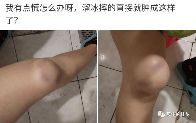 溜冰摔了膝盖关节处肿了,溜冰摔倒了膝盖不能弯曲