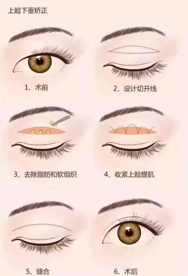 眼睑内翻和眼睑缺损能同时手术吗,眼睑缺损能修复和正常一样完美吗