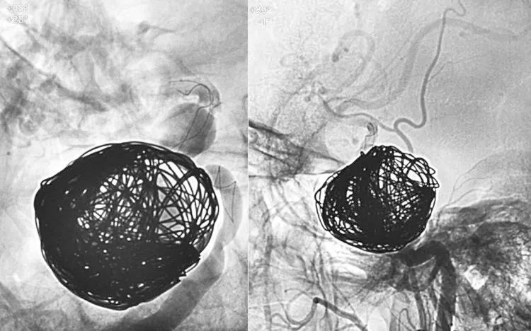 国外怎么治疗动脉瘤,全世界颅内动脉瘤最佳的治疗