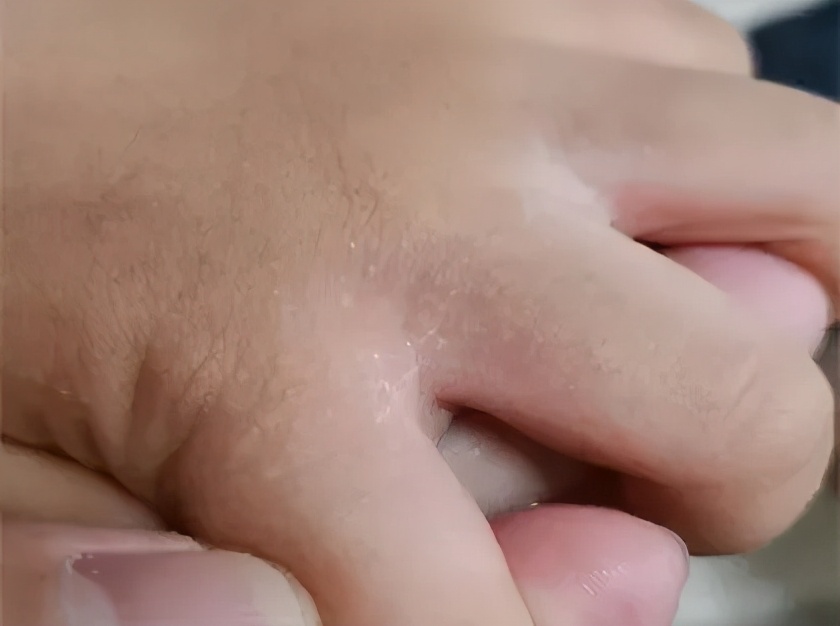 手上长一片小疙瘩还痒是怎么回事,天一热手上就起一层小疙瘩还很痒