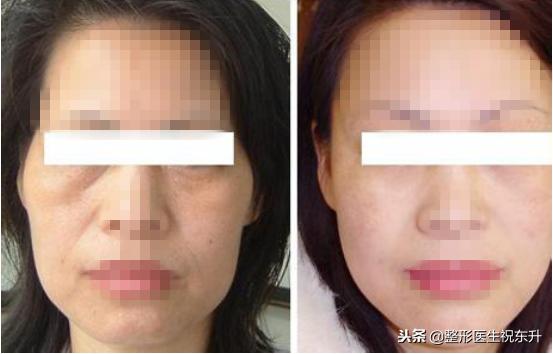 鼻唇沟泪沟法令纹,18岁有眼沟纹和法令纹怎么办