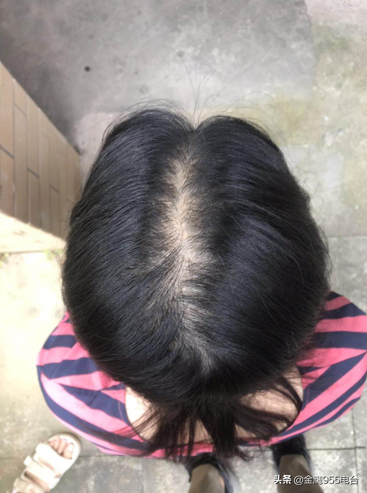 养发馆能治好脱发吗,各种养发馆真能治好脱发吗