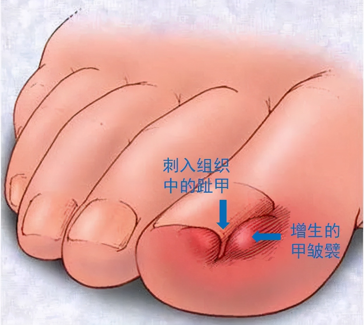 女生指甲太短甲沟炎,指甲剪成什么形状不得甲沟炎