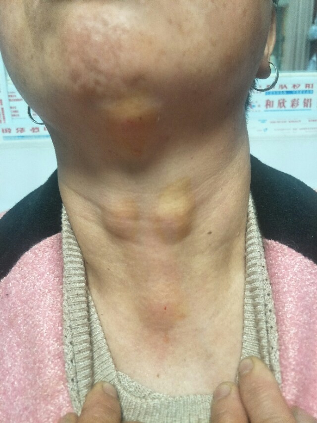 穴位注射治疗慢性咽喉炎图片,治疗咽喉炎扎针有效果吗